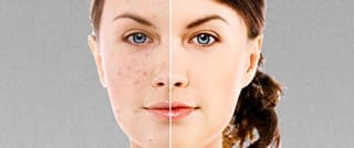 image link to article aboutn argan oil and acne 